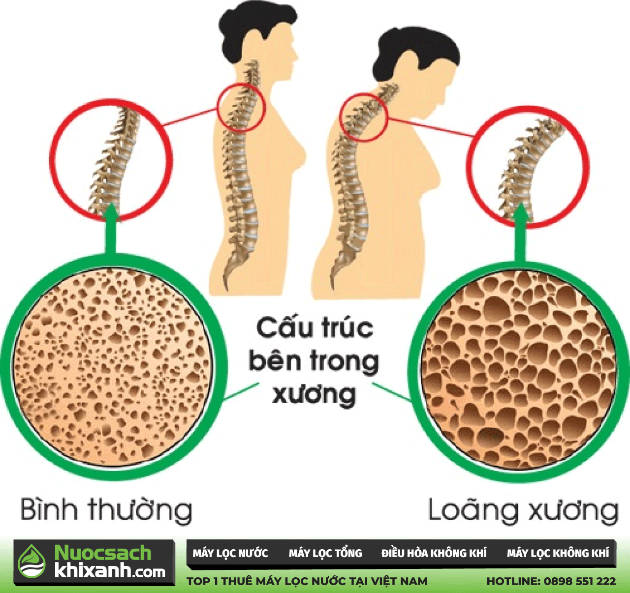 Sử dụng nước uống không an toàn nguy cơ gây bệnh loãng xương